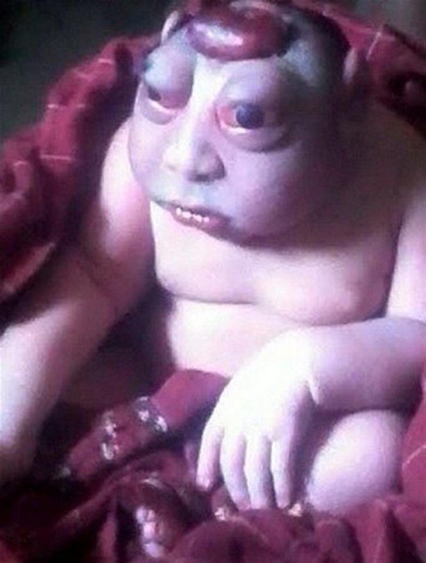 Foto - İşte Dünyanın en garip hastalıkları