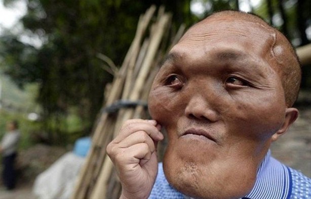 Foto - İşte Dünyanın en garip hastalıkları