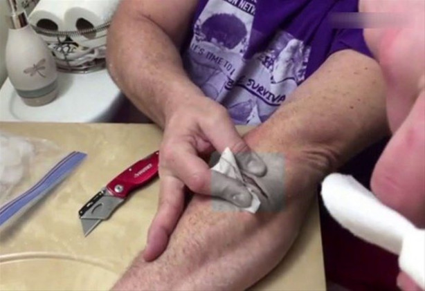 Foto - Mideniz kaldırmayabilir! Kolundaki kisti kendi çıkardı!