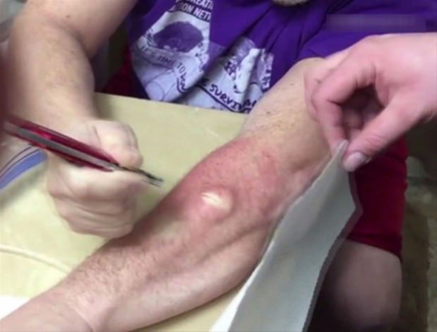 Foto - Mideniz kaldırmayabilir! Kolundaki kisti kendi çıkardı!