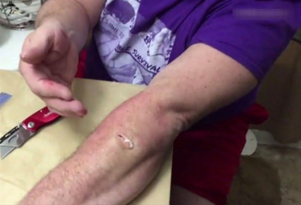 Foto - Mideniz kaldırmayabilir! Kolundaki kisti kendi çıkardı!