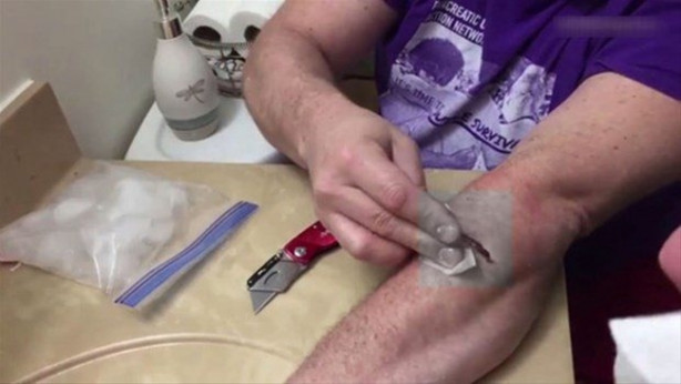 Foto - Mideniz kaldırmayabilir! Kolundaki kisti kendi çıkardı!