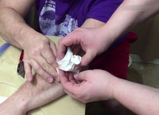 Foto - Mideniz kaldırmayabilir! Kolundaki kisti kendi çıkardı!