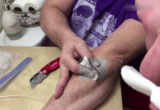 Foto - Mideniz kaldırmayabilir! Kolundaki kisti kendisi çıkardı!