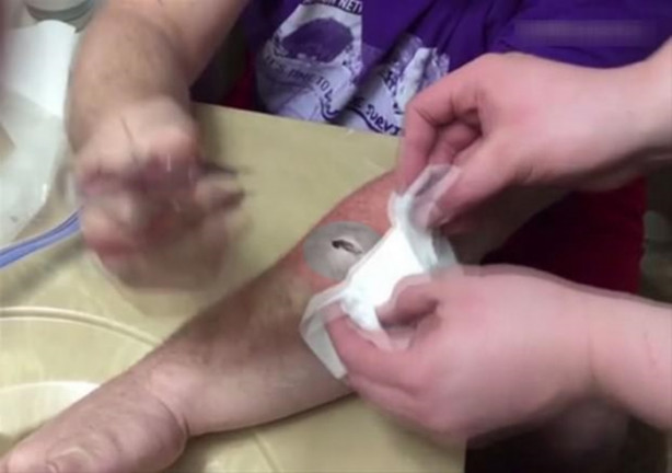 Foto - Mideniz kaldırmayabilir! Kolundaki kisti kendisi çıkardı!