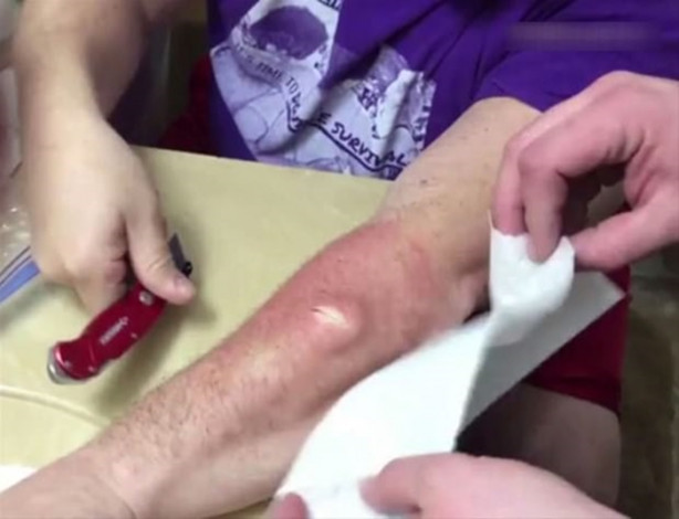 Foto - Mideniz kaldırmayabilir! Kolundaki kisti kendisi çıkardı!