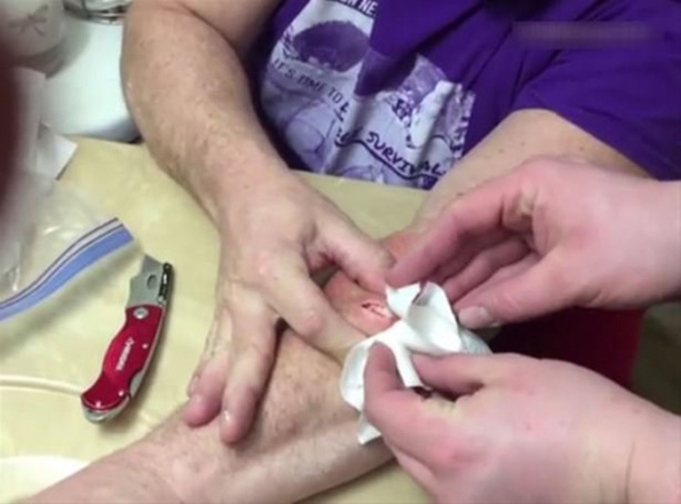 Foto - Mideniz kaldırmayabilir! Kolundaki kisti kendisi çıkardı!