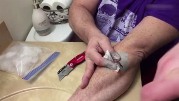 Foto - Mideniz kaldırmayabilir! Kolundaki kisti kendisi çıkardı!