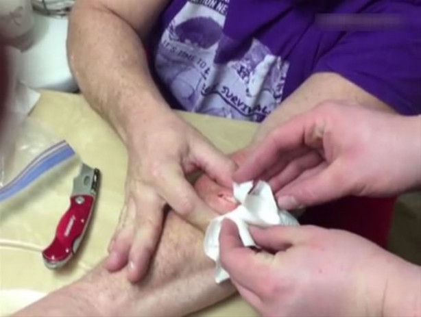 Foto - Mideniz kaldırmayabilir! Kolundaki kisti kendisi çıkardı!