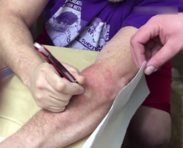 Mideniz kaldırmayabilir! Kolundaki kisti kendisi çıkardı!