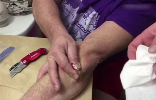 Foto - Mideniz kaldırmayabilir! Kolundaki kisti kendisi çıkardı!