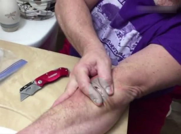 Foto - Mideniz kaldırmayabilir! Kolundaki kisti kendisi çıkardı!