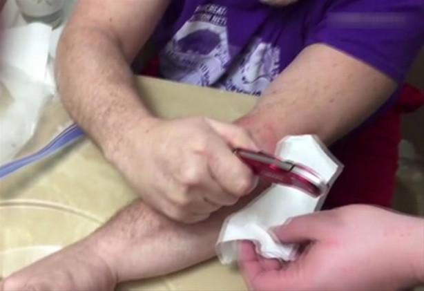 Foto - Mideniz kaldırmayabilir! Kolundaki kisti kendisi çıkardı!