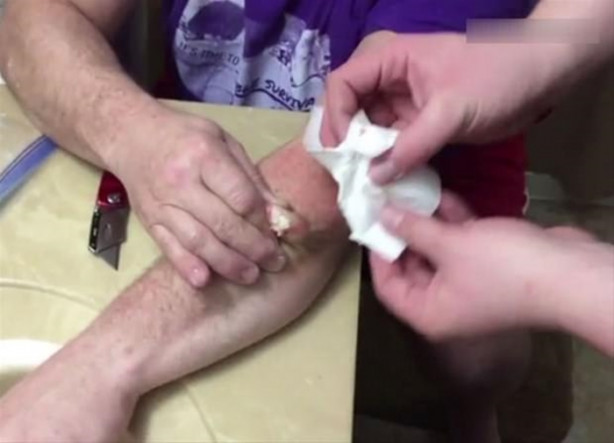 Foto - Mideniz kaldırmayabilir! Kolundaki kisti kendisi çıkardı!