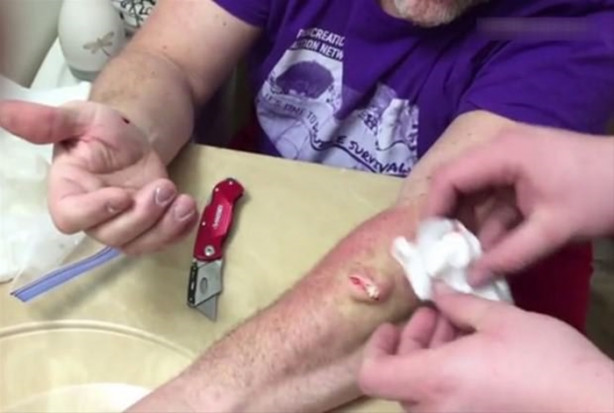 Foto - Mideniz kaldırmayabilir! Kolundaki kisti kendisi çıkardı!