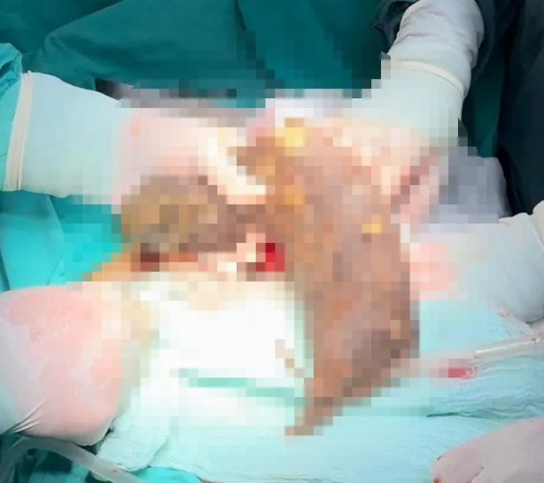 Foto - Midesinden çıkanlara doktorlar bile inanamadı! Hatay'da inanılmaz olay