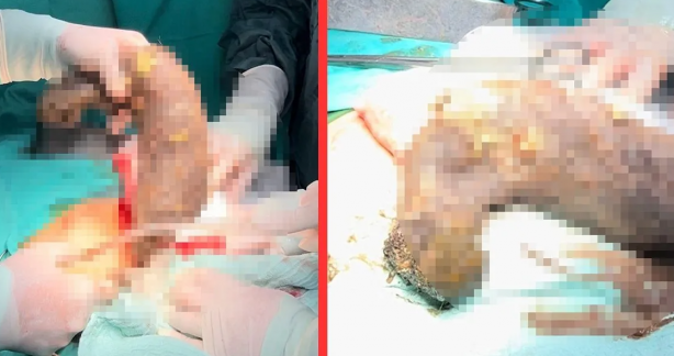 Midesinden çıkanlara doktorlar bile inanamadı! Hatay'da inanılmaz olay