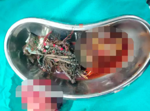 Foto - Midesinden çıkanlarla sergi açılır! Öyle şeyler çıktı ki doktorlar bile şaştı kaldı