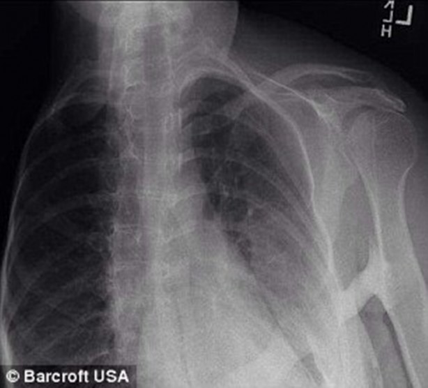 Foto - Milyonda bir görülen hastalık: Kemikleri yok oluyor!