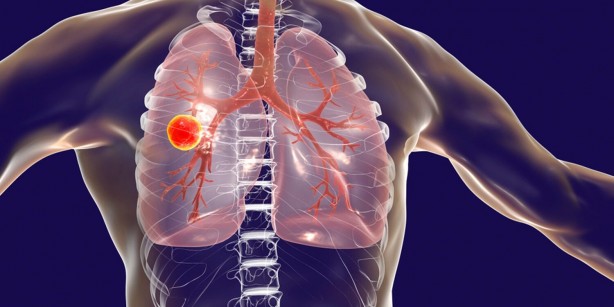 Foto - Milyonlarca kişi her an ölebilir! Uzman isim Türkiye'ye duyurdu: ölümle karşı karşıya, tüberküloz yeniden hortladı! 