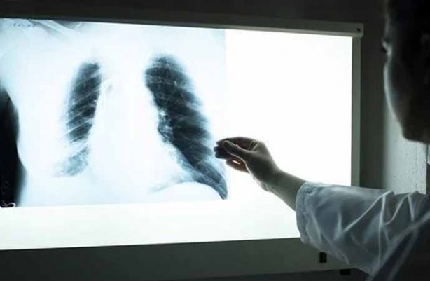 Foto - Milyonlarca kişi her an ölebilir! Uzman isim Türkiye'ye duyurdu: ölümle karşı karşıya, tüberküloz yeniden hortladı! 