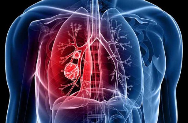 Foto - Milyonlarca kişi her an ölebilir! Uzman isim Türkiye'ye duyurdu: ölümle karşı karşıya, tüberküloz yeniden hortladı! 