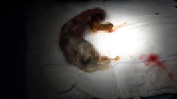 Foto - Minik kızın midesinden çıkanlar dehşete düşürdü!