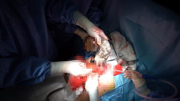 Foto - Minik kızın midesinden çıkanlar dehşete düşürdü!