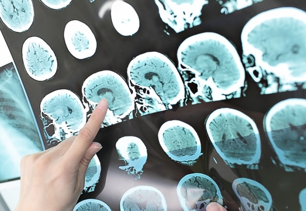 Foto - MS hastalığı tedavisinde büyük gelişme!