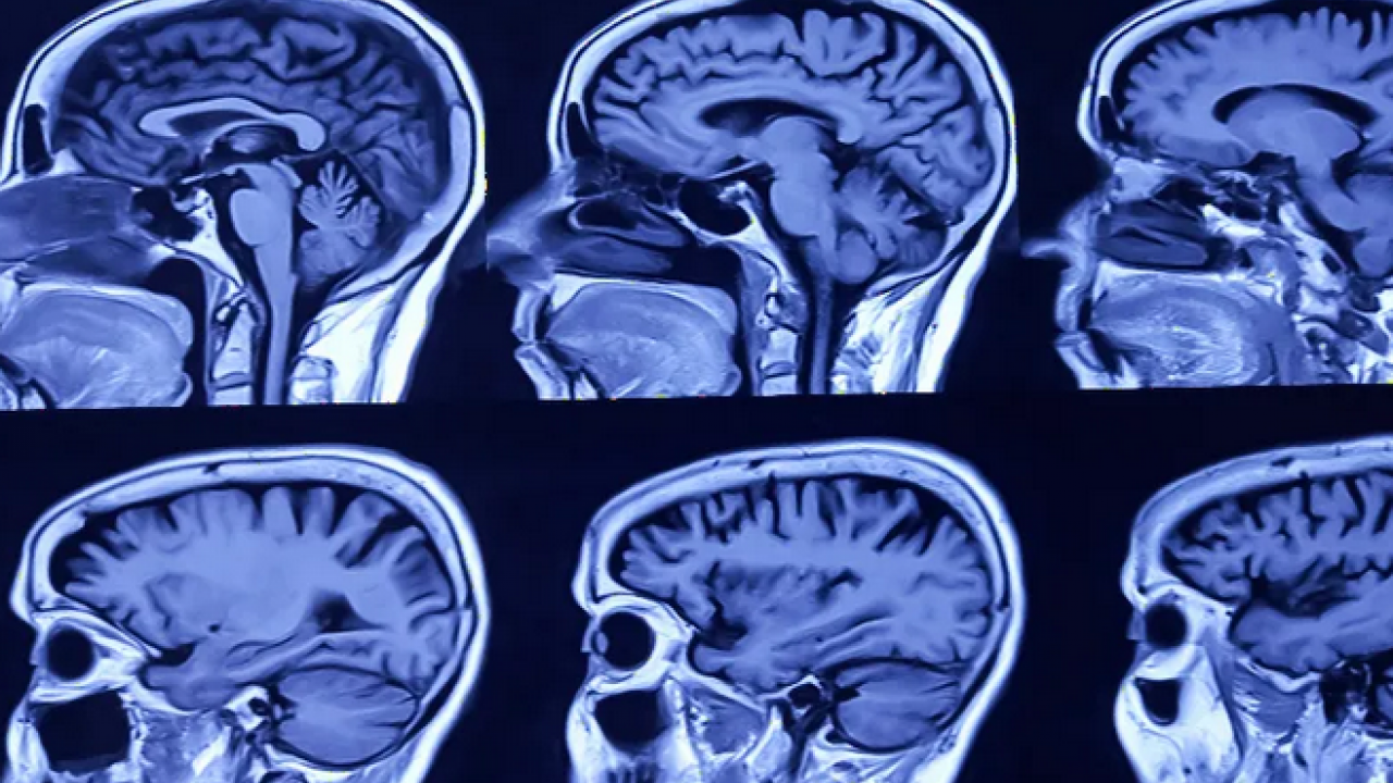 Foto - Ms tedavisinde yenilikçi adımlar umut vadediyor! Heyecanlandıran gelişme: Yana yakıla araştırmaya başladılar