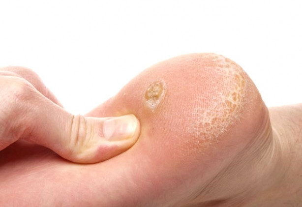 Foto - Nasır bir günde nasıl geçer? İşte cevabı!