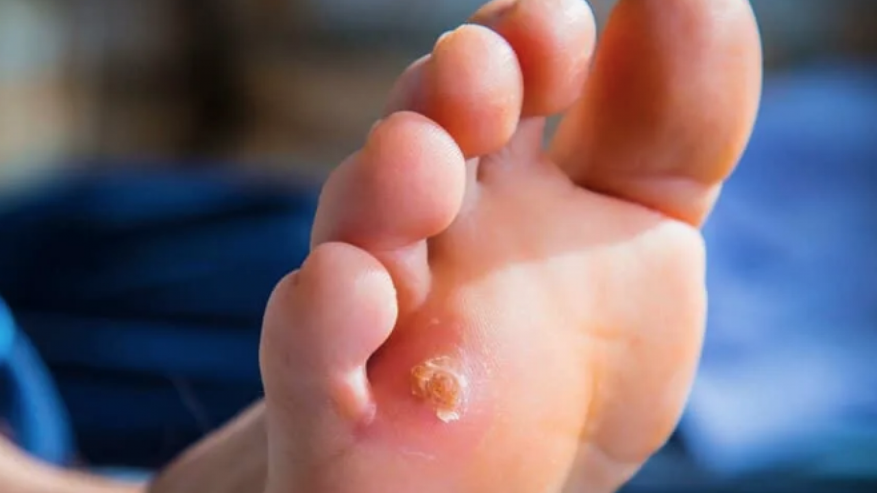 Nasır için tedavi yöntemleri: Ayaklardaki nasır problemini çözen yöntem! İlk dikkat edilmesi gerekenler! Uzak durun