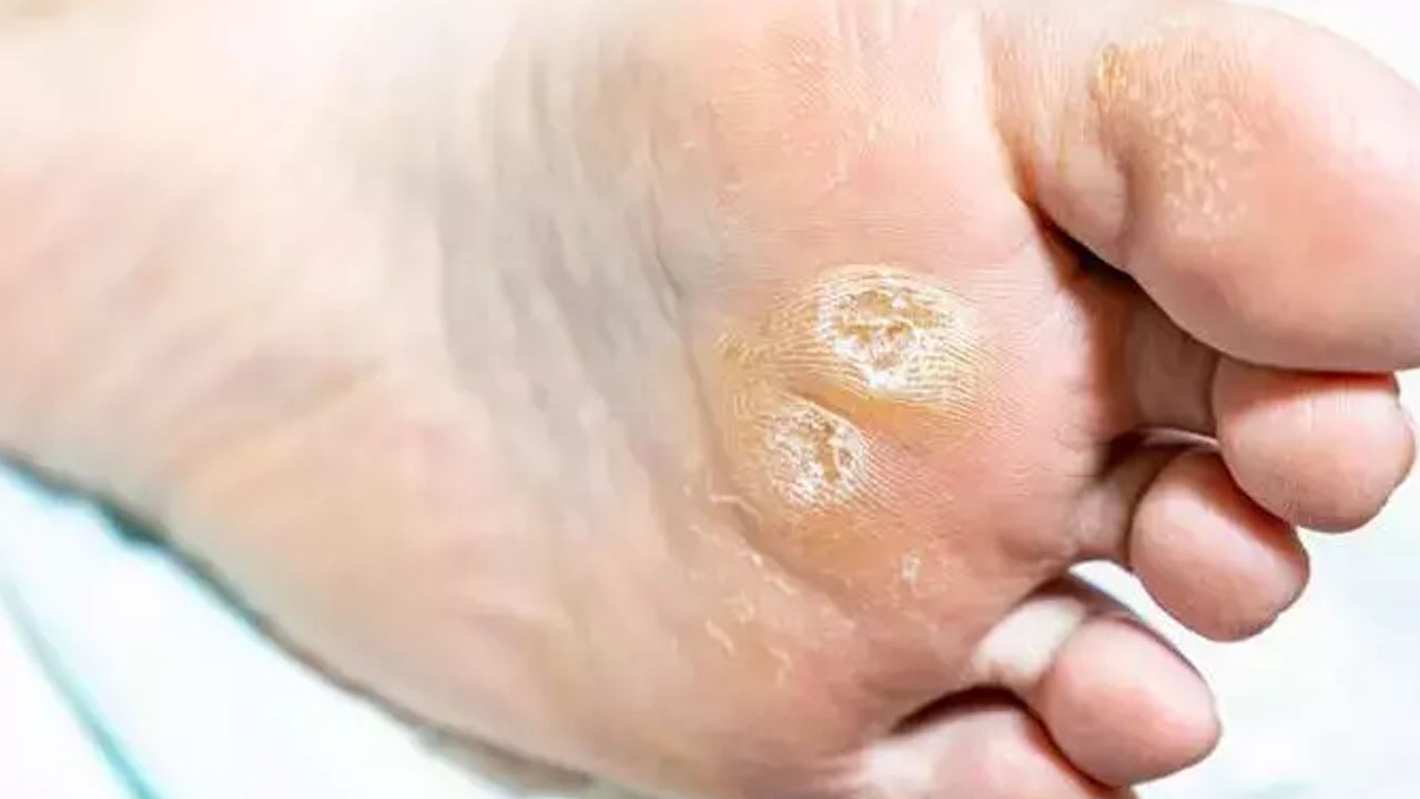 Nasır, mantar ve egzamanın kökünü kurutuyor! Bunu yapın