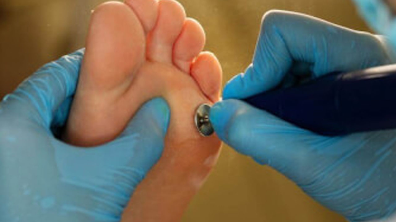 Foto - Nasır, mantar ve egzamanın kökünü kurutuyor! Bunu yapın