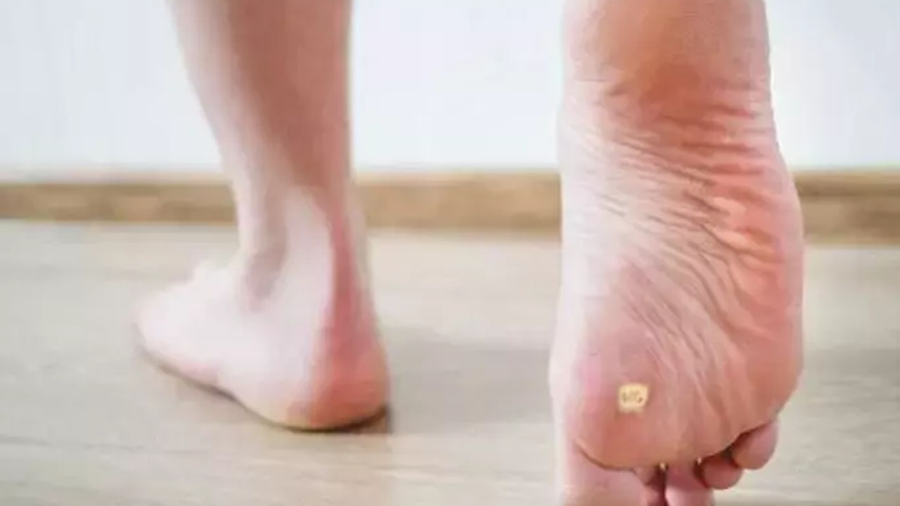 Foto - Nasır, mantar ve egzamanın kökünü kurutuyor! Bunu yapın