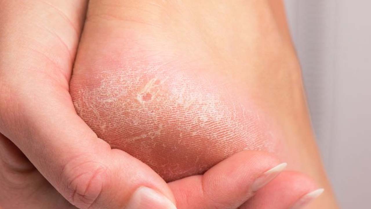 Nasır, mantar ve egzamanın kökünü kurutuyor! 