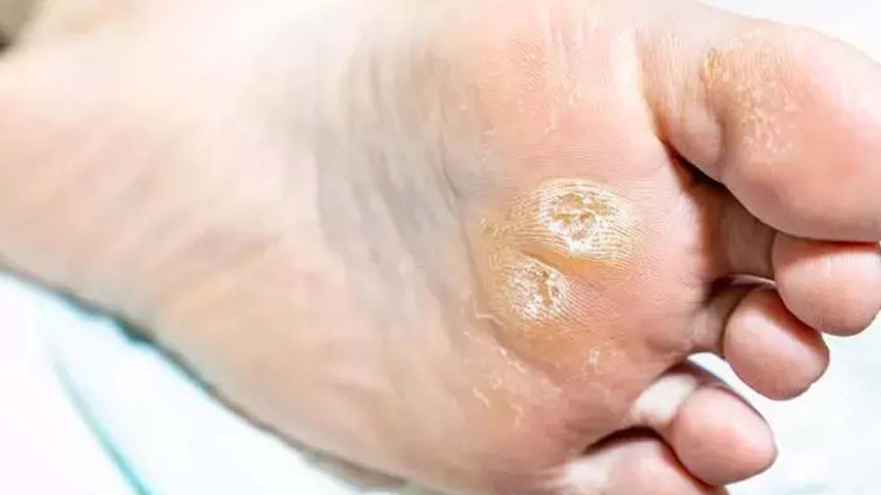 Foto - Nasır, mantar ve egzamanın kökünü kurutuyor! 