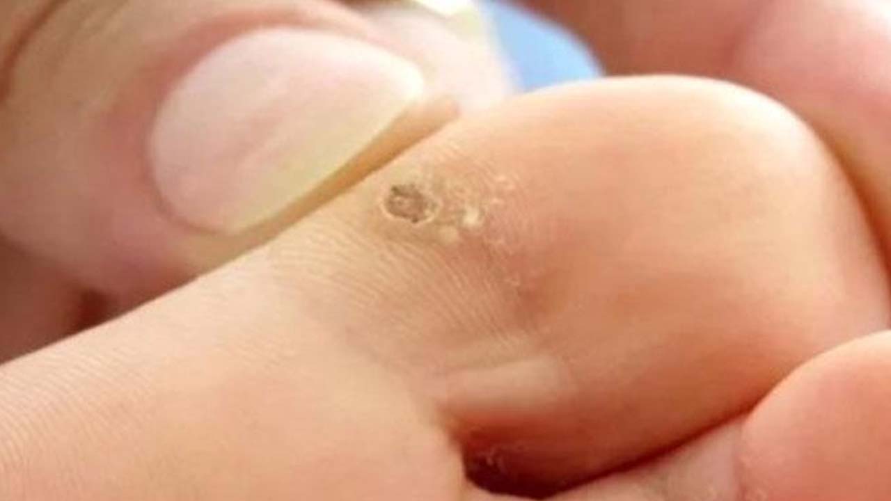 Foto - Nasır, mantar ve egzamanın kökünü kurutuyor! 