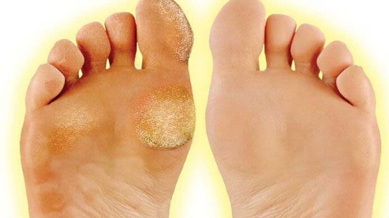 Foto - Nasır, mantar ve egzamanın kökünü kurutuyor! 