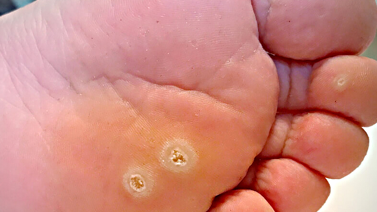 Foto - Nasırın üzerine 1 damla damlatın! Ayağı pamuk gibi yapıyor: Mutlaka deneyin ve rahatlayın...