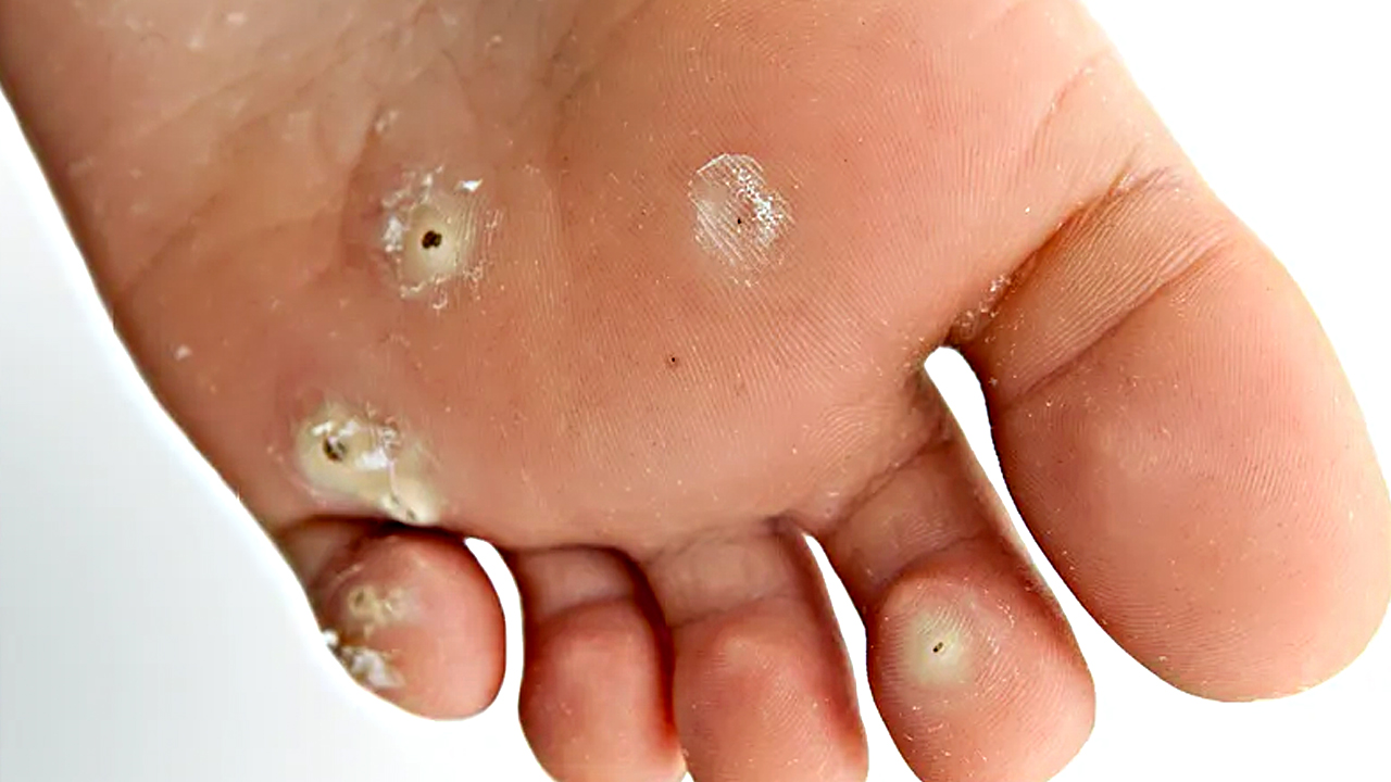 Foto - Nasırın üzerine 1 damla damlatın! Ayağı pamuk gibi yapıyor: Mutlaka deneyin ve rahatlayın...