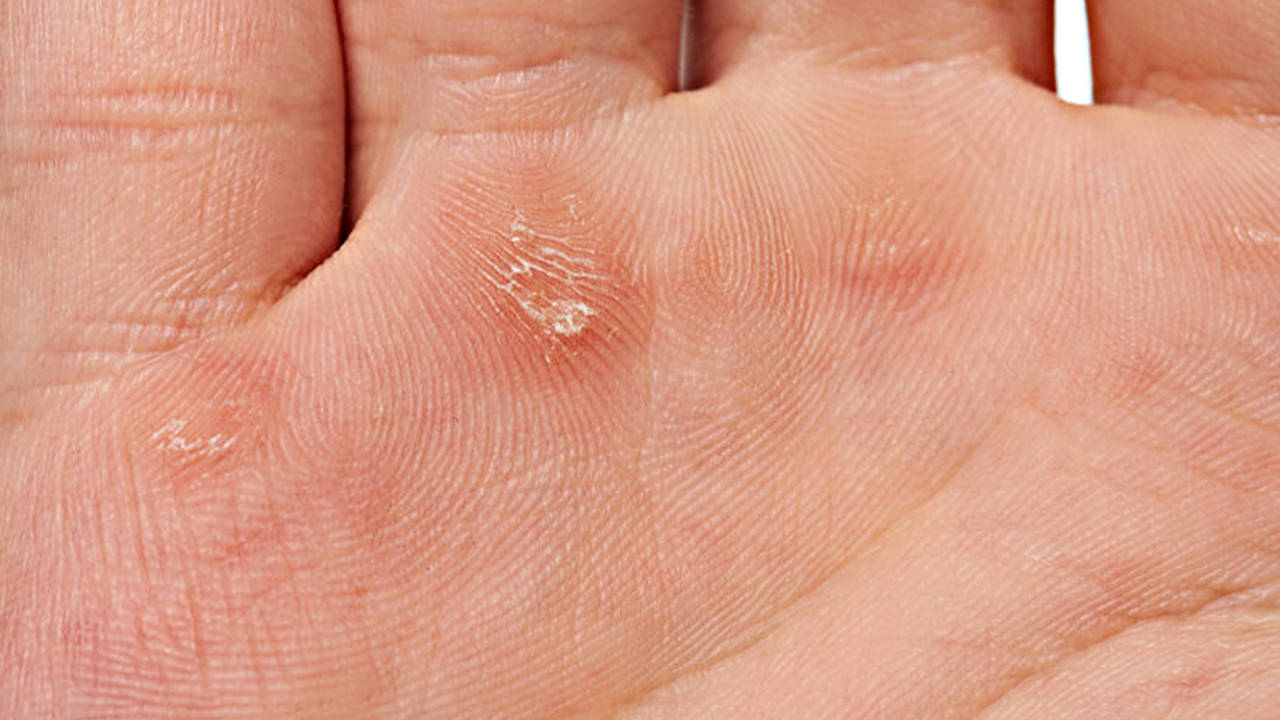 Foto - Nasırın üzerine 1 damla damlatın! Ayağı pamuk gibi yapıyor: Mutlaka deneyin ve rahatlayın...