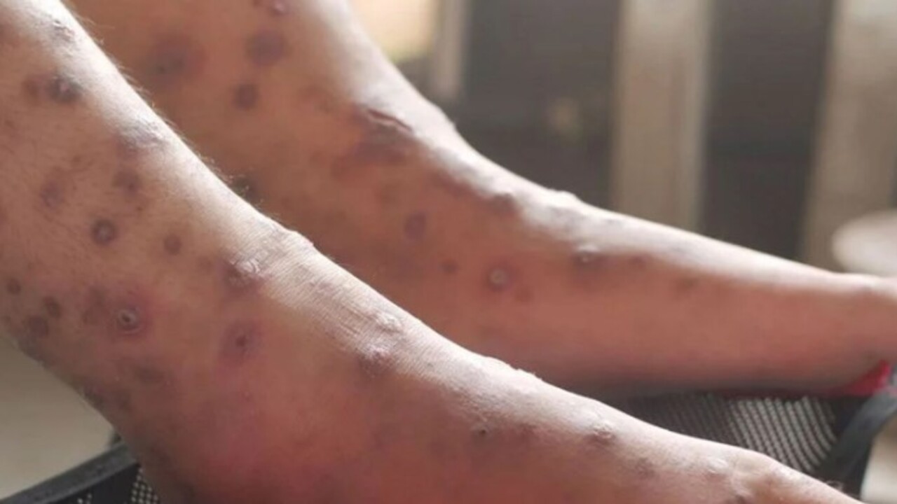 Foto - Ne koronavirüs ne kanser! Dünya yeni ölümcül hastalıkla karşı karşıya! Yayılması an meselesi