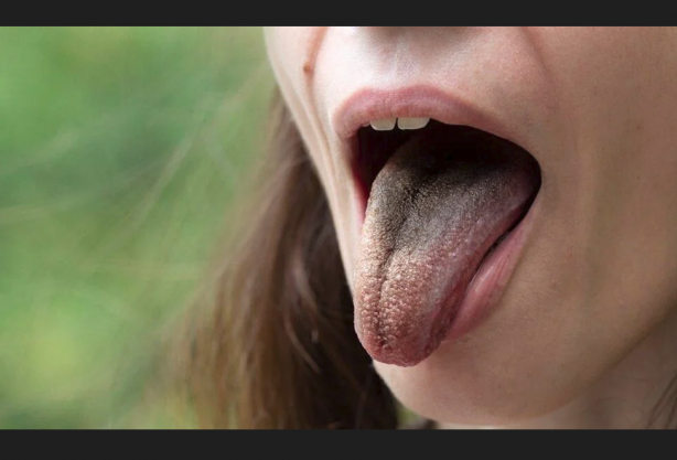 Foto - Ne olduğu duyunca şaşkına döneceksiniz Antibiyotik dilini bu hale getirdi