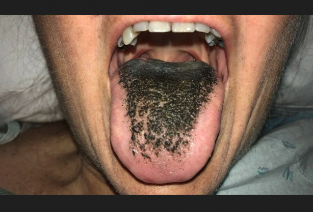 Foto - Ne olduğu duyunca şaşkına döneceksiniz Antibiyotik dilini bu hale getirdi