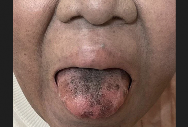 Foto - Ne olduğu duyunca şaşkına döneceksiniz Antibiyotik dilini bu hale getirdi