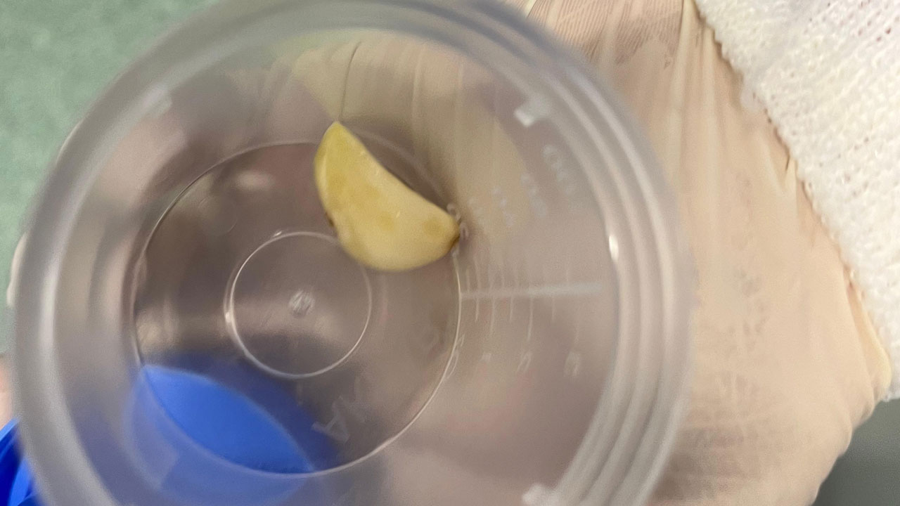 Foto - Nefes almakta zorlanınca hastaneye gitti! Akciğerinden çıkan şey herkesi şaşırttı