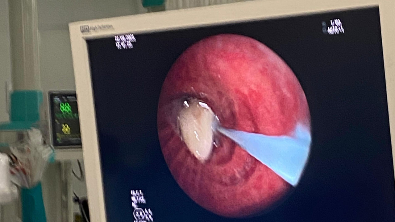 Foto - Nefes almakta zorlanınca hastaneye gitti! Akciğerinden çıkan şey herkesi şaşırttı