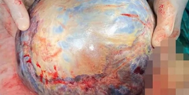 Foto - Nefes darlığı şikayetiyle hastaneye giden kadının karnından öyle bir şey çıktı ki!