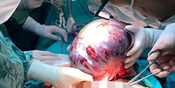 Foto - Nefes darlığı şikayetiyle hastaneye giden kadının karnından öyle bir şey çıktı ki!